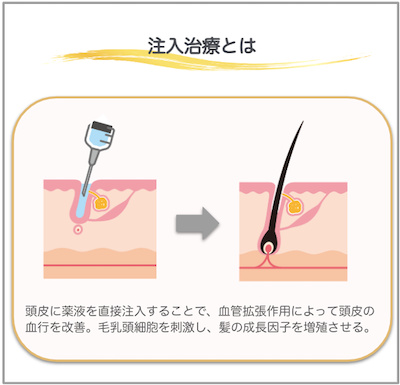 注入治療とは