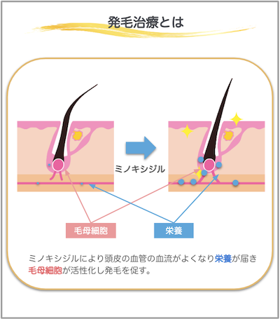 発毛治療とは