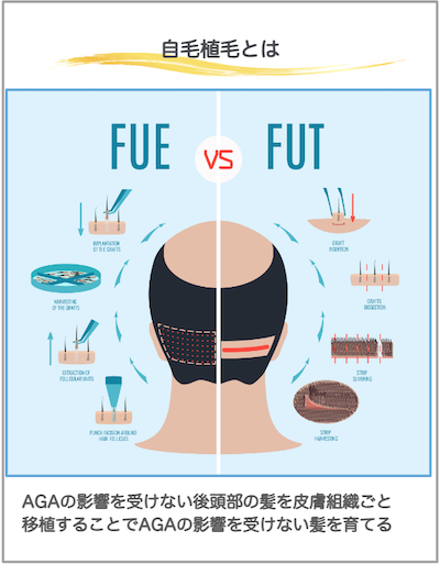 自毛植毛とは