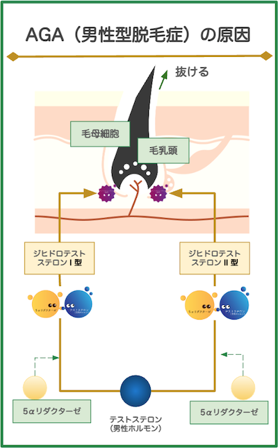 AGA男性型脱毛症の原因