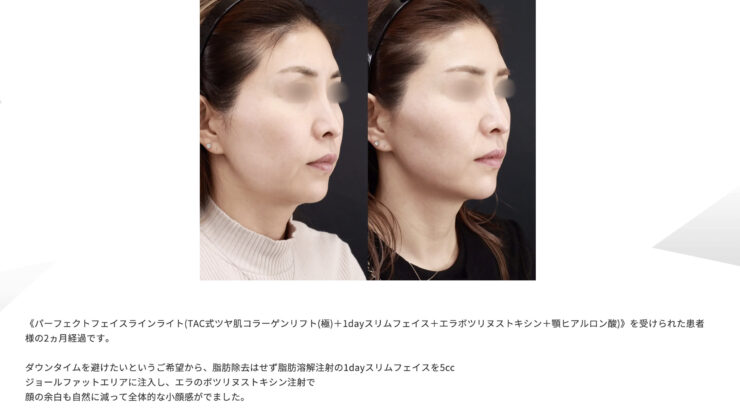 東京で脂肪溶解注射が人気のおすすめクリニック10選！選び方を徹底解説│beauty-column