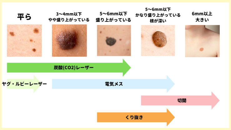 東京でほくろ除去が安いおすすめ人気皮膚科クリニック10選！口コミ評判も│beauty-column