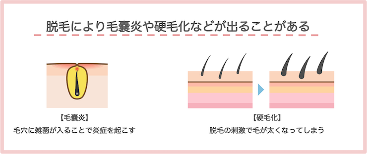 毛嚢炎硬毛化