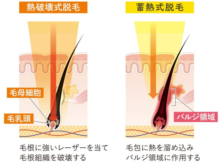 YAGレーザーなどの熱破壊式レーザーで脱毛できるクリニックを選ぶ