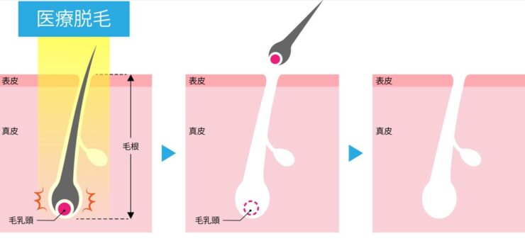 医療脱毛