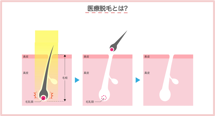 医療脱毛とは