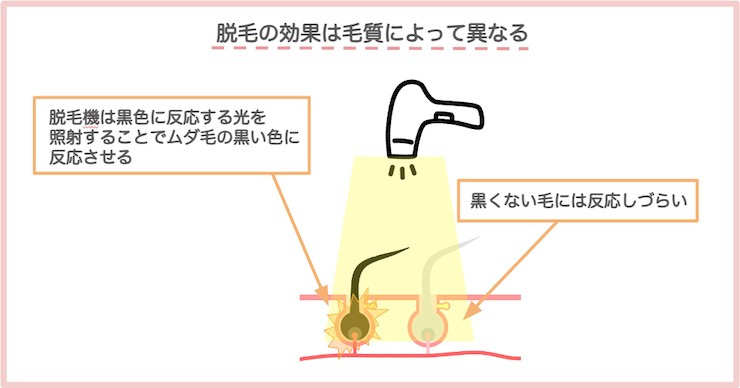 脱毛効果毛質