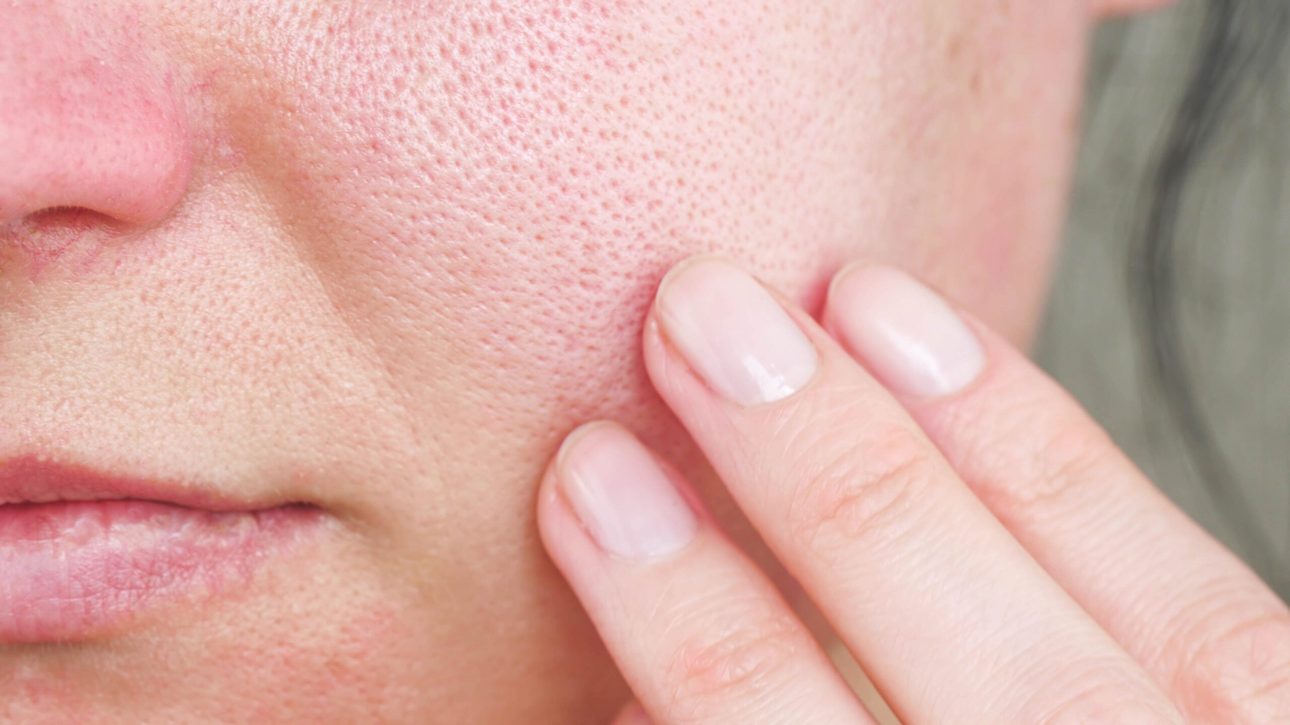 昆明皮肤管理中心：毛孔粗大的类型和原因 - 哔哩哔哩