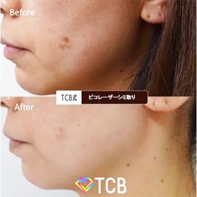 TCBのピコレーザーの症例